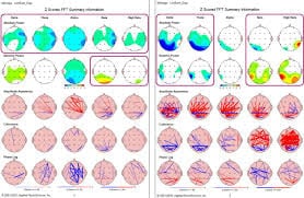 typical qeeg Brainmap done in Neuroguide