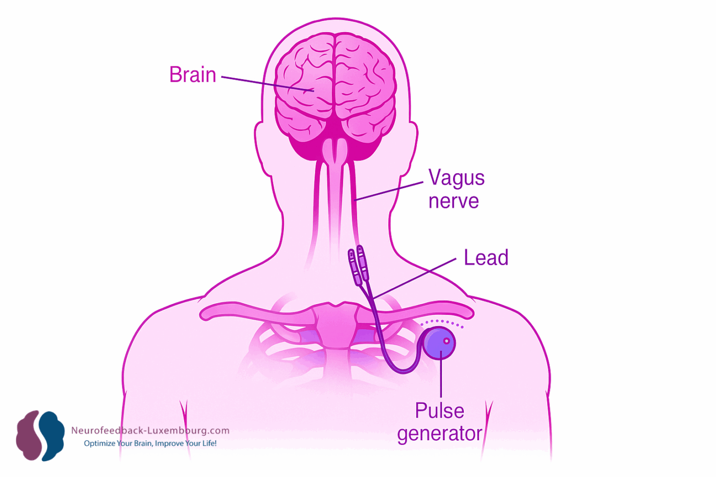 Visuel tPBM post VNS implant